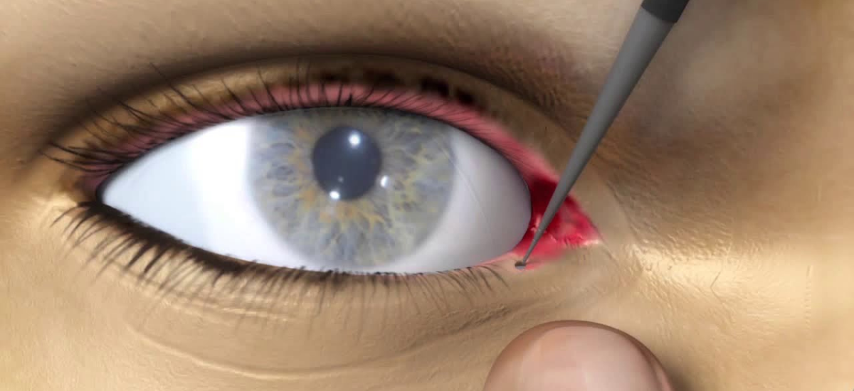 What are punctal plugs? sponsored by Trio Eyecare